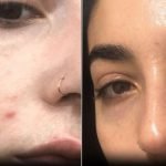 Accutane for Acne Scars: Effective Treatments That Really Work