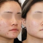 Acne Scar Laser: Effective Solutions for Smooth, Clear Skin