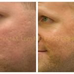 Acne Scars before And After: Stunning Transformations Revealed