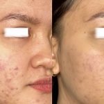 Acne Scars Laser: Effective Solutions for Flawless Skin