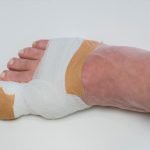 After Care for Toe Nail Removal: Essential Tips for Quick Healing