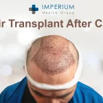 After Hair Transplant Care: Essential Tips for Fast Healing