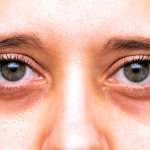 Allergy Eyes Dark Circles: Effective Remedies to Brighten Your Look