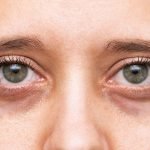 Anemia Dark Eye Circles: Causes, Remedies & Prevention Tips