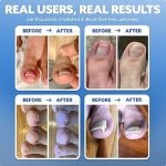 Care of Toe After Nail Removal: Essential Tips for Fast Healing