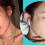 Celebrity Acne Scar: Effective Treatments Celebrities Swear By