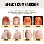 Damaged Nail Care: Expert Tips for Quick Nail Recovery