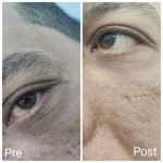 Dark Circles under Eyes Surgery: Transform Your Look Today