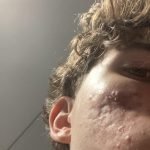 Does Accutane Help With Acne Scars? Truths You Need to Know