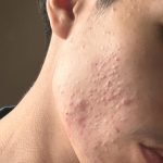 Does Adapalene Help With Acne Scars? Proven Results Revealed