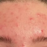 Does Arazlo Help With Acne Scars: Effective Treatment Insights