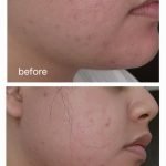 Does Azelaic Acid Help With Acne Scars? Proven Results Revealed