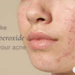 Does Benzoyl Peroxide Help With Acne Scars? Proven Results Revealed