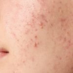 Does Niacinamide Help With Acne Scars: Proven Skin-Healing Benefits