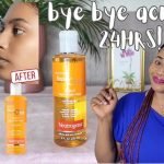 Does Toner Help With Acne Scars? Effective Tips Revealed