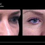 Eliminate Dark Circles under Eyes: Proven Tips for Bright, Fresh Look