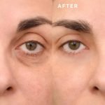 Eye Fillers for Dark Circles: Restore Youthful, Bright Eyes Fast