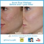 Facial for Acne Scars: Effective Treatments to Restore Clear Skin