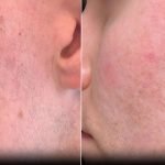 Honey for Scars from Acne: Natural Healing Tips That Work