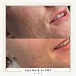 How Many Microneedling Sessions for Acne Scars: Ultimate Guide