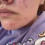 How to Get Rid of Acne Scars Reddit: Proven Tips That Work Fast