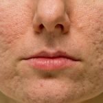 How to Prevent Acne Scars: Expert Tips for Clear Skin Fast