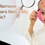 How to Remove Acne Scars Naturally in a Week: Fast, Proven Tips
