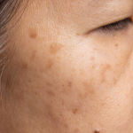 Hyperpigmentation Acne Scars: Effective Treatments That Work Fast