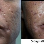 Ice Pick Acne Scars before And After: Stunning Transformations Revealed