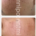 Korean Skincare before And After: Stunning Transformations Revealed