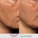Laser Fraxel Acne Scars: Transform Your Skin with Proven Results