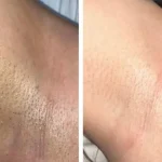Laser Hair Removal After Care: Essential Tips for Smooth Skin