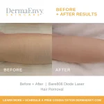 Laser Hair Removal Care After: Essential Tips for Smooth Skin