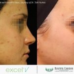 Laser Surgery for Acne Scars Price: Affordable Treatments Unveiled