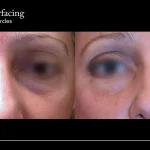 Laser Surgery for Dark Circles under Eyes: Effective & Safe Solutions
