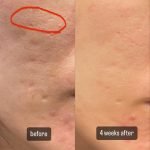 Microneedling Length for Acne Scars: Ultimate Guide to Best Results