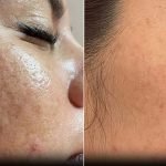 Microneedling Prp Acne Scars: Ultimate Treatment for Clear Skin