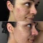 Red Light Treatment for Acne Scars: Effective Healing Secrets Revealed