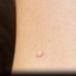 Tea Tree Oil And Skin Tags: Effective Natural Removal Tips