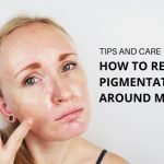 Tips for Reducing Hyperpigmentation: Effective & Proven Strategies