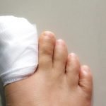 Toe Care After Nail Removal: Essential Tips for Fast Healing