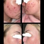 Tretinoin Cream Cleared Up Acne Scars: Proven Clear Skin Solution