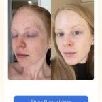 Vitamin C Skin before And After: Stunning Transformations Revealed