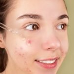 Azelaic Acid Skincare Routine: Clear, Radiant Skin Secrets Revealed